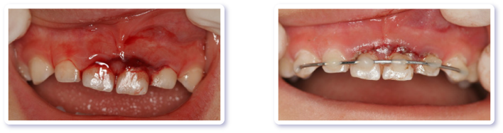 ２．歯や口のケガ(外傷)の治療